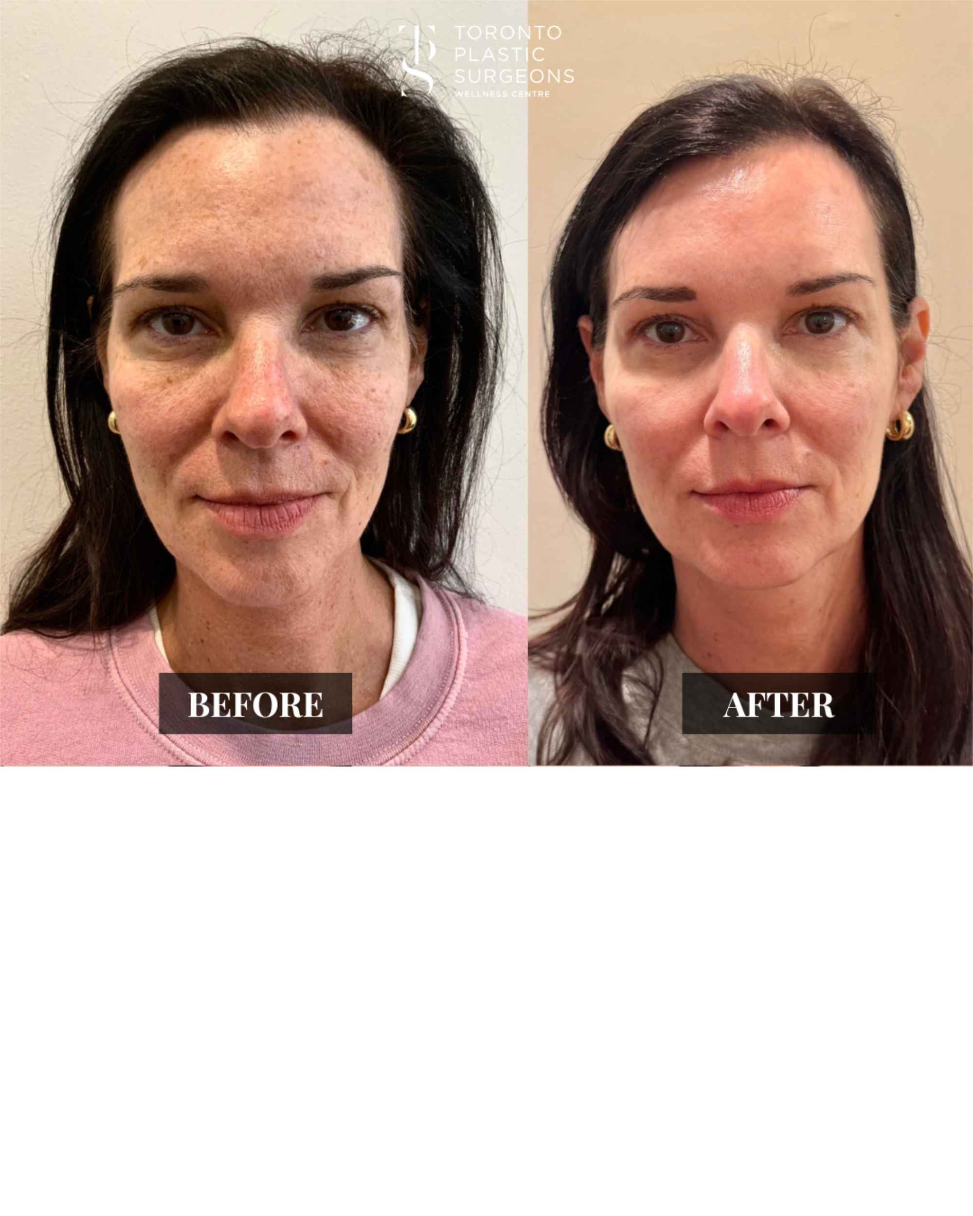 Front-view before and after comparison of a female patient at Toronto Plastic Surgeons Wellness Centre showing clearer, more even skin tone with reduced pigmentation and freckling across the cheeks and forehead.