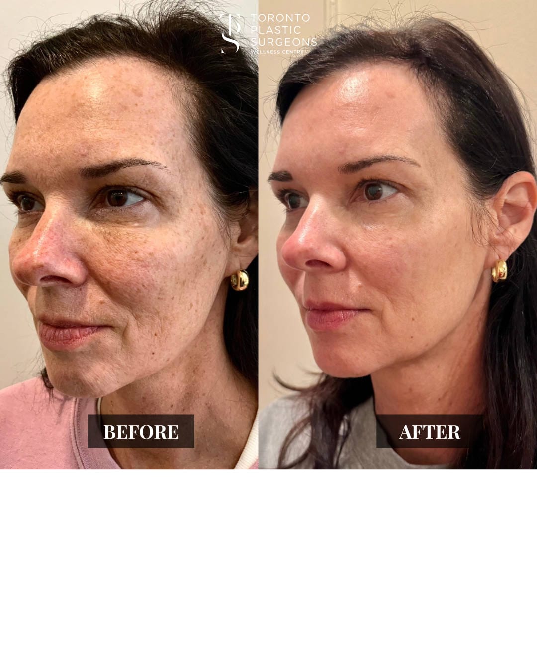 Right three-quarter view before and after comparison of a female patient at Toronto Plastic Surgeons Wellness Centre showing clearer, more even skin with reduced freckling and pigmentation across the cheek and nose.