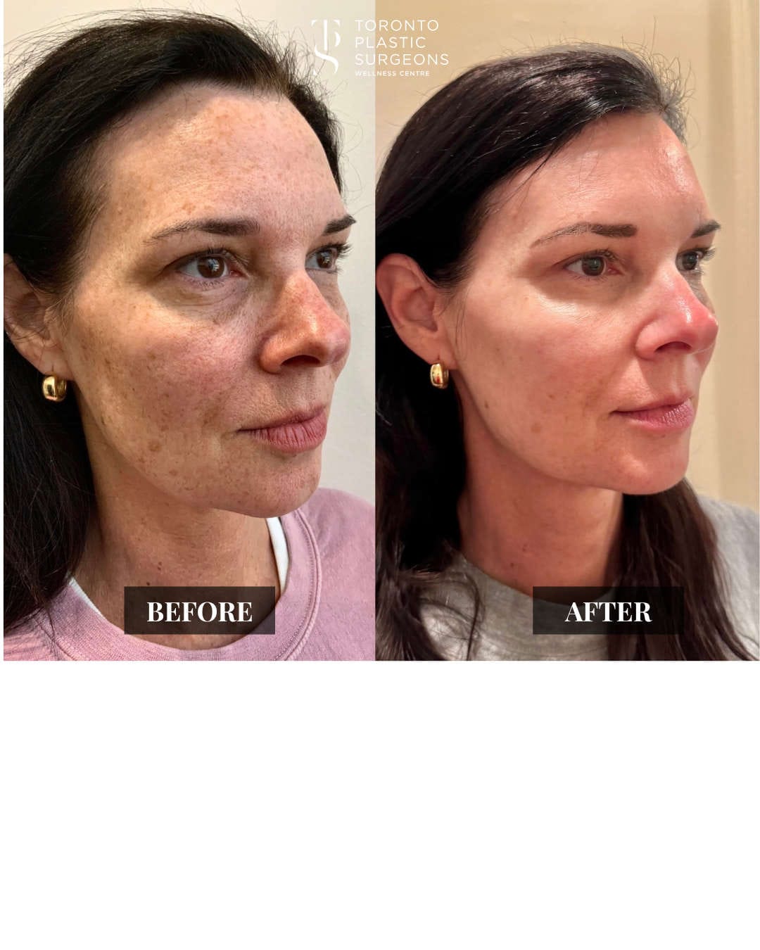 Left three-quarter view before and after comparison of a female patient at Toronto Plastic Surgeons Wellness Centre showing reduced freckling and sun damage with brighter, smoother skin across the cheek.
