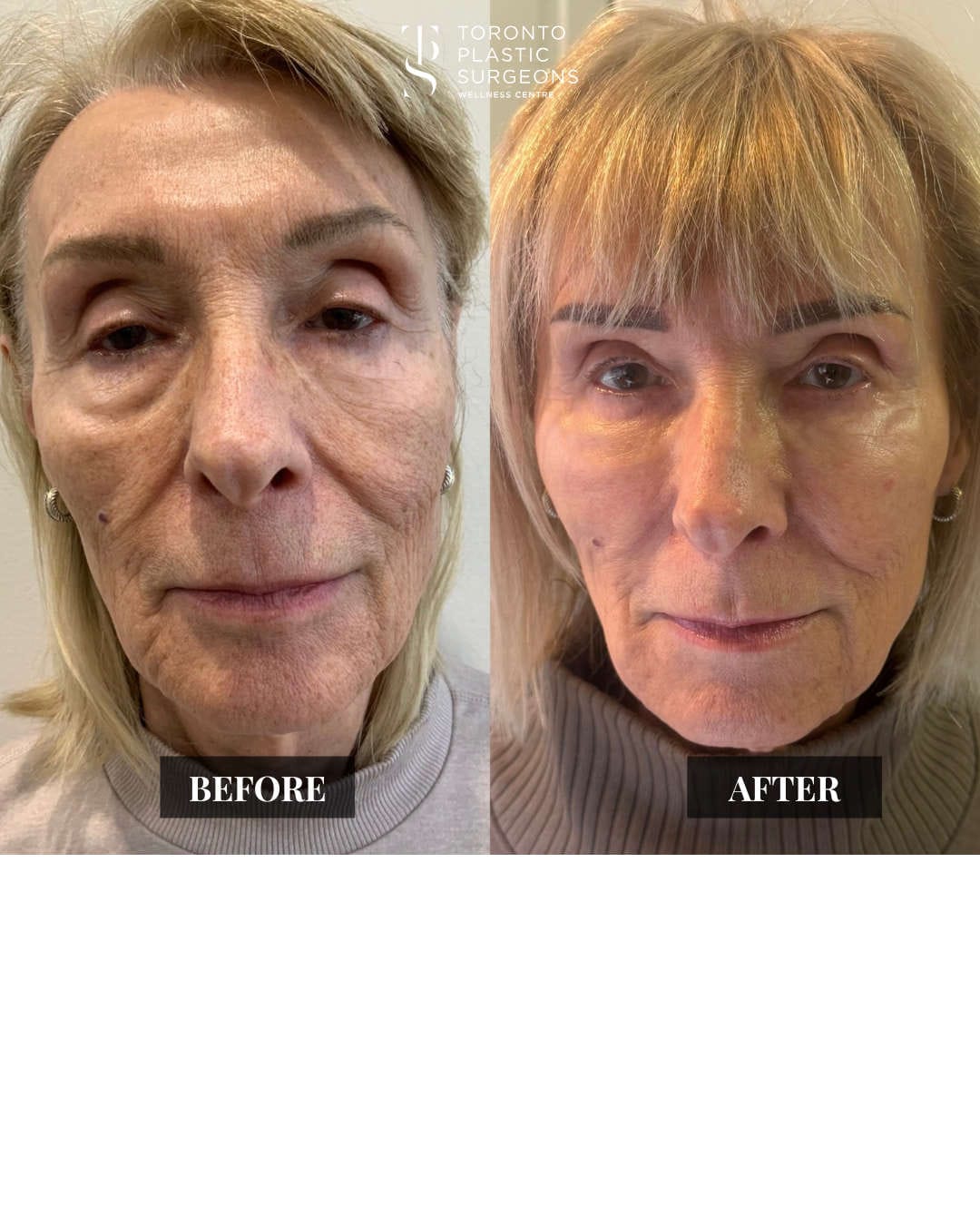 Front-view before and after comparison of a female patient at Toronto Plastic Surgeons Wellness Centre showing brighter, more even skin tone, reduced pigmentation, and smoother texture across the cheeks and around the mouth.