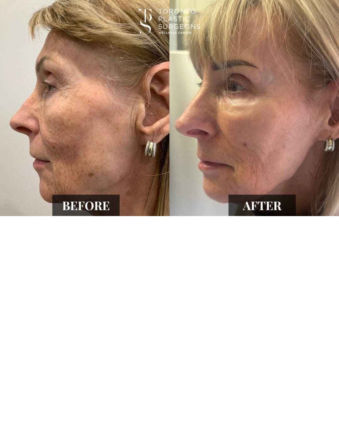 Left profile before and after comparison of a female patient at Toronto Plastic Surgeons Wellness Centre showing smoother skin texture, reduced pigmentation and sun spots, and softened fine lines across the cheek and jaw.