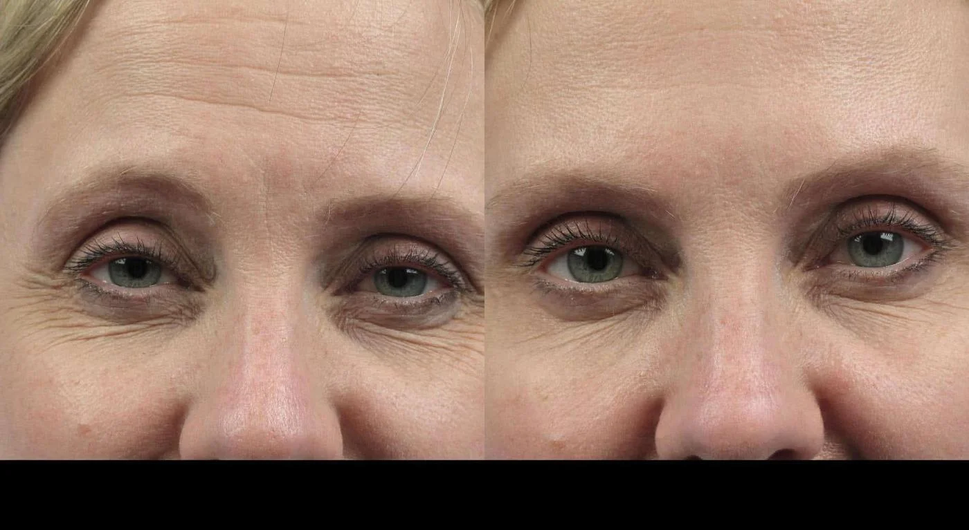 Before and after photo of a patient receiving Botox treatment in Toronto, showing reduced forehead wrinkles.