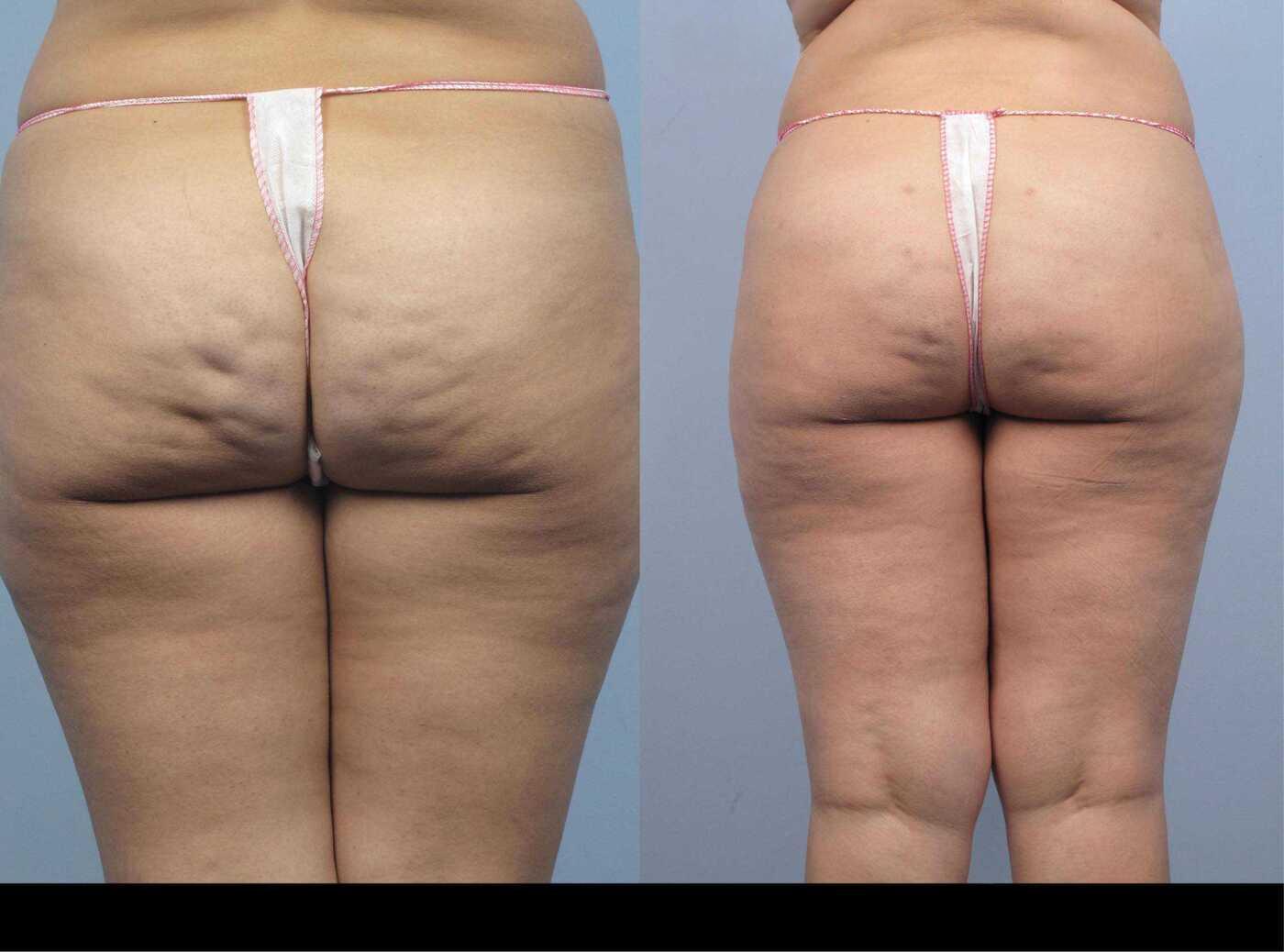 Before and after image of cellulite treatment in Toronto showing smoother skin and reduced dimpling on the back of the thighs and buttocks.