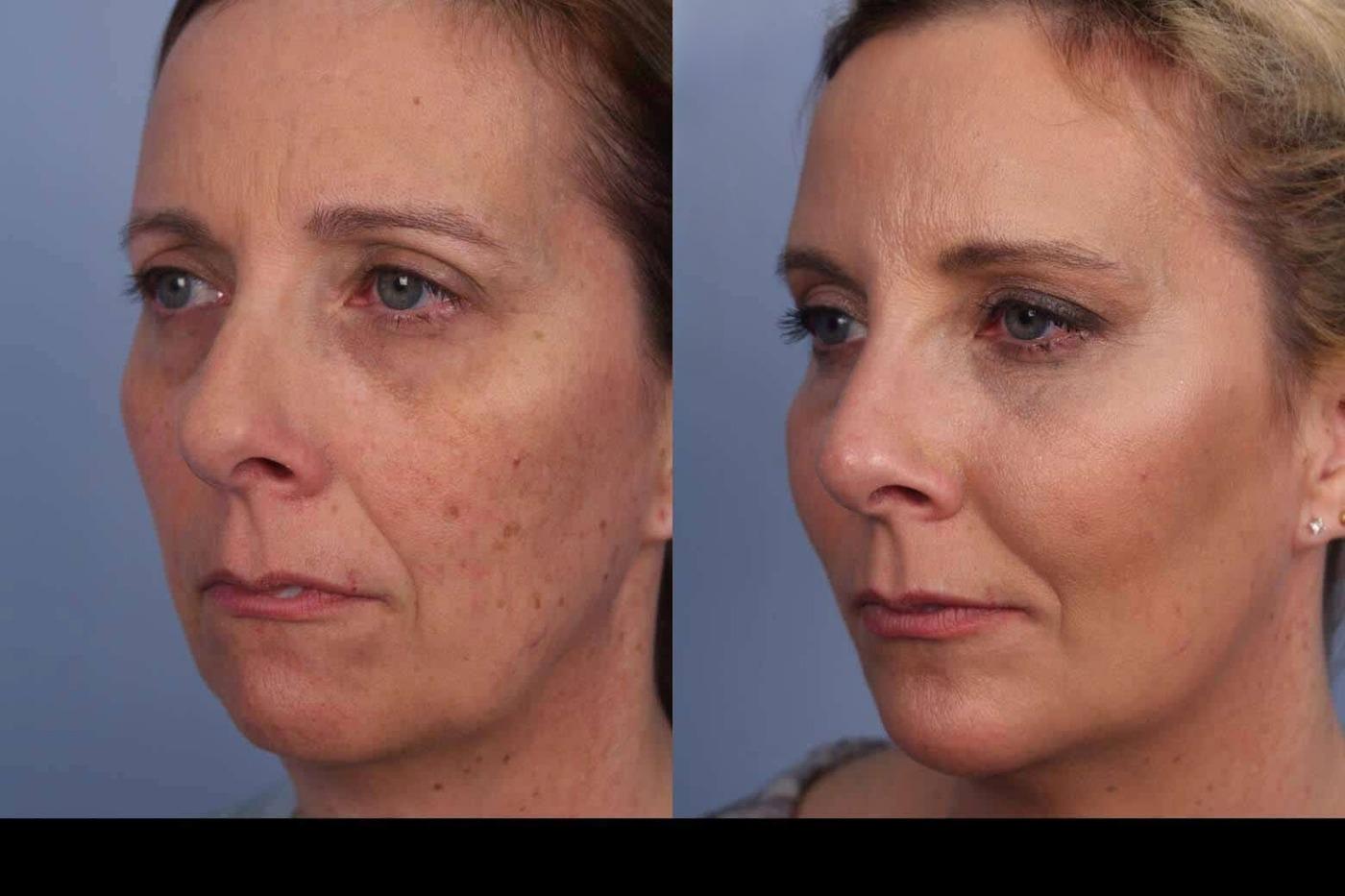 Photo 1 of a Patient Before and After IPL Photofacial Treatment in Toronto.
