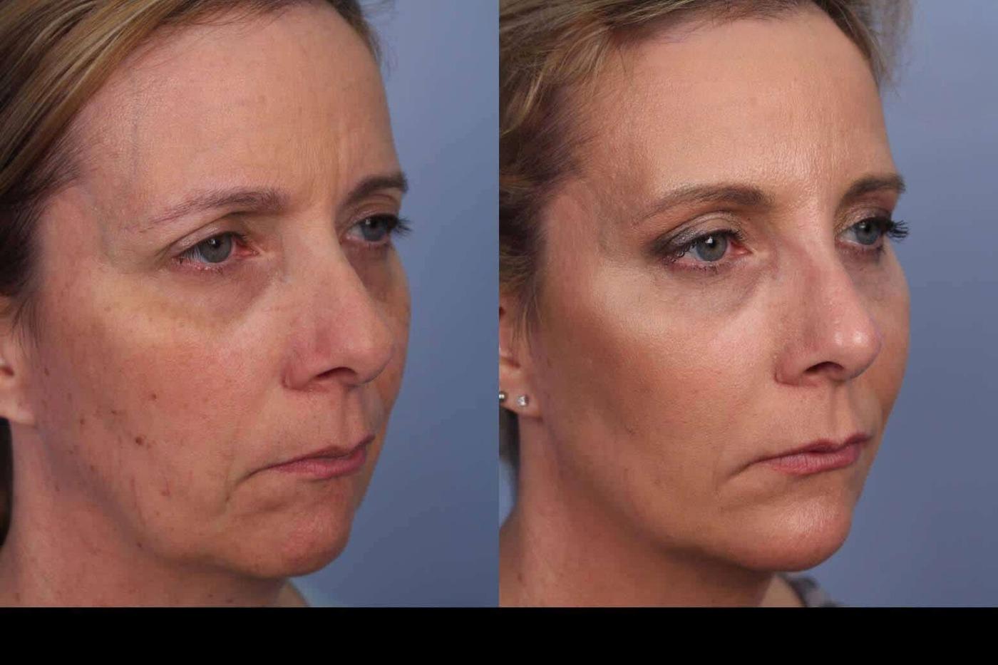 Photo 1 of a Patient Before and After Microdermabrasion in Toronto