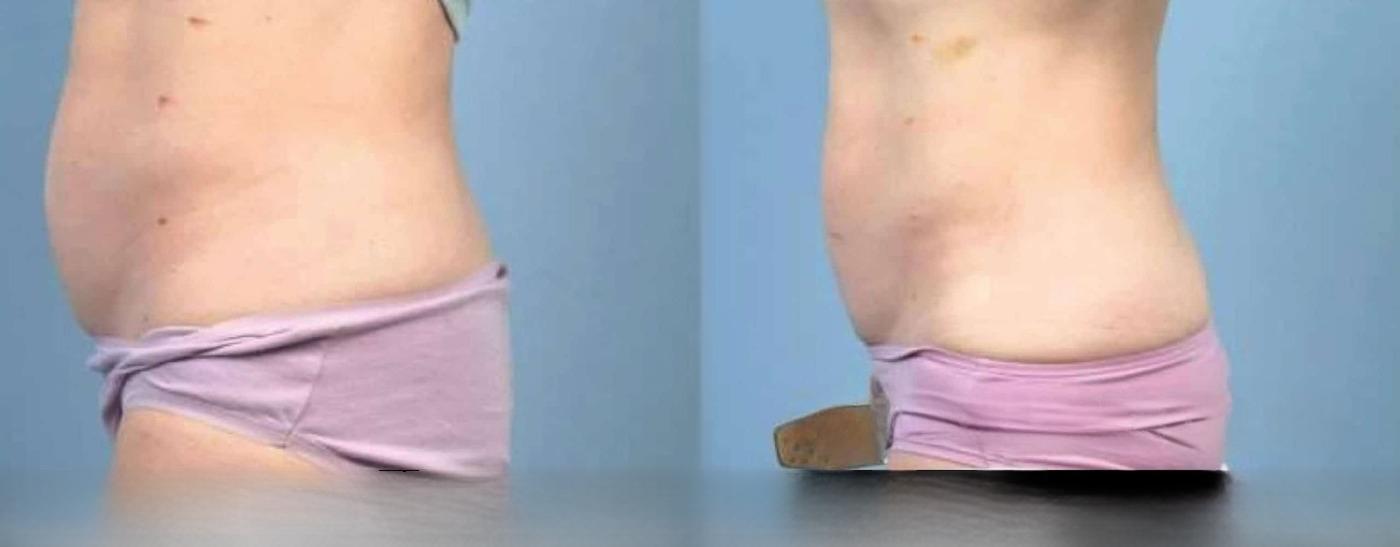 Photo 1 of a Patient Before and After Non-Surgical Body Contouring in Toronto.