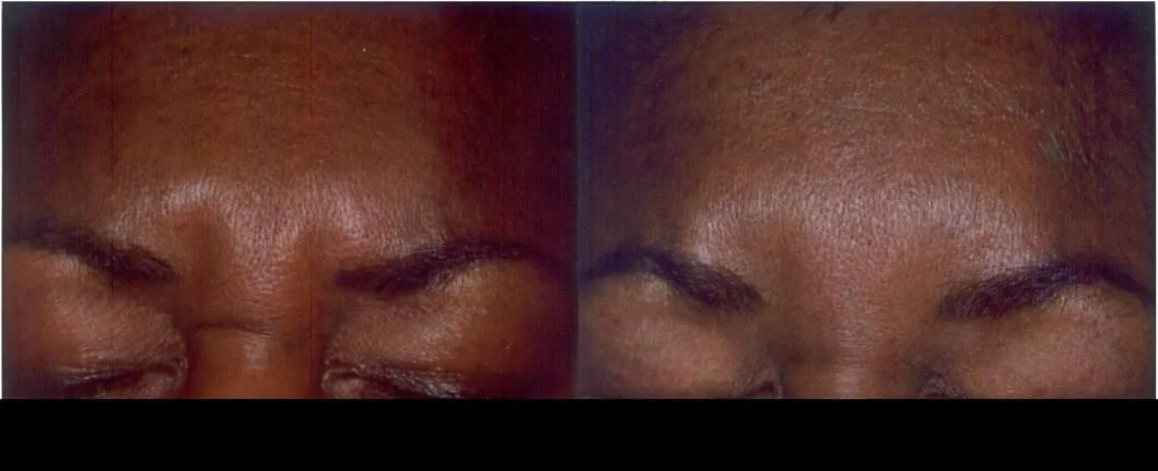 Botox in Toronto before and after results featuring reduced wrinkles and smoother skin on the patient's forehead.