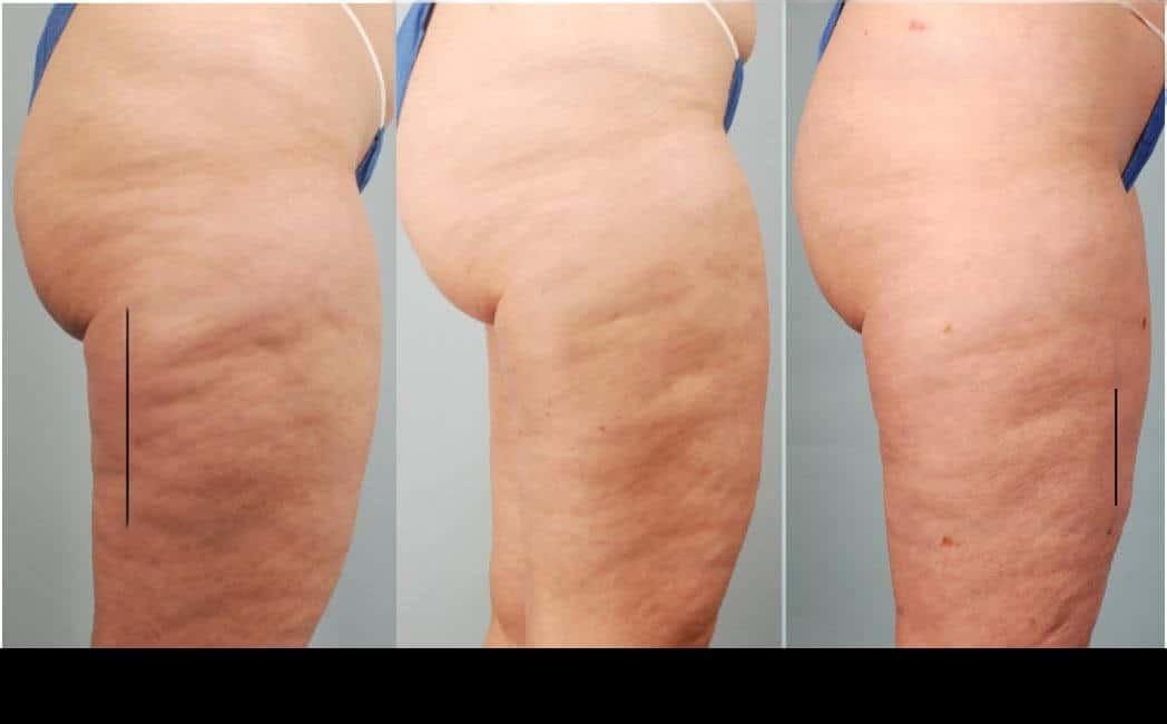 Before and after image of cellulite treatment in Toronto showcasing a noticeable reduction in cellulite and smoother skin on the patient's thighs.