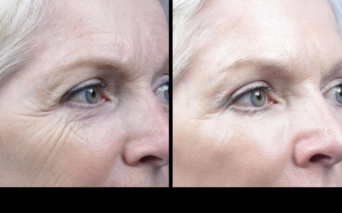 Photo 10 of a Patient Before and After Microdermabrasion in Toronto
