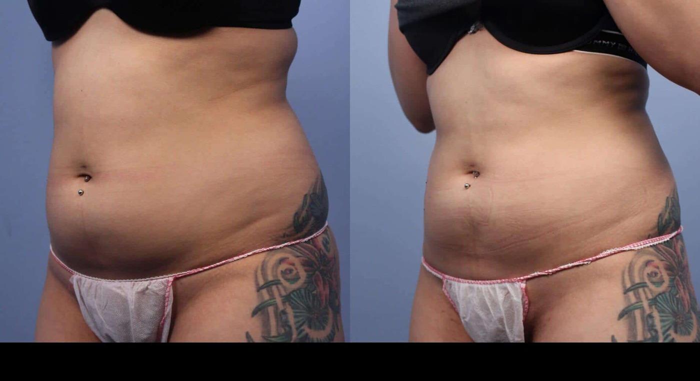 Photo 10 of a Patient Before and After Non-Surgical Body Contouring in Toronto.