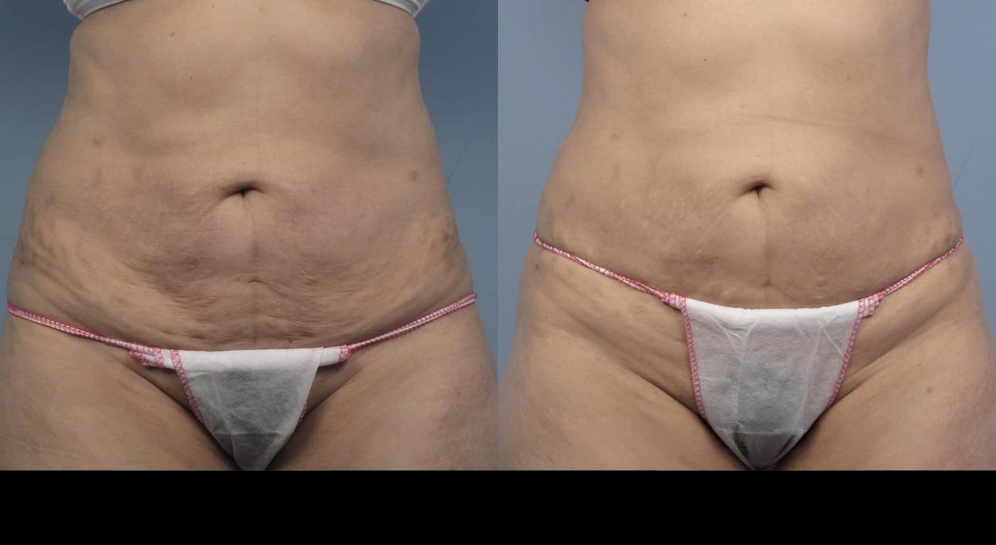Photo 10 of a Patient Before and After Non-Surgical Liposuction in Toronto.