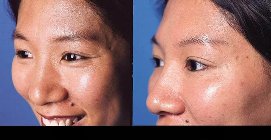 Before and after Botox in Toronto image displaying a noticeable improvement in skin smoothness and wrinkle reduction.