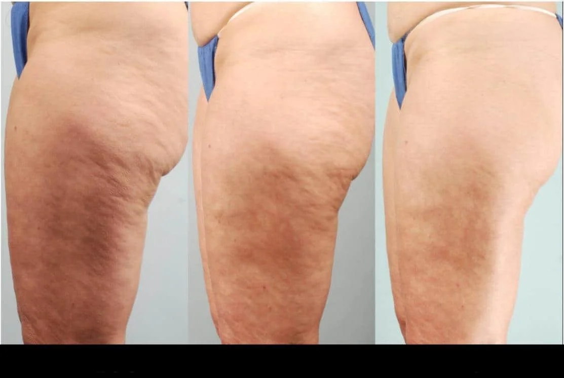 Before and after results of cellulite removal in Toronto, showcasing smoother skin texture.