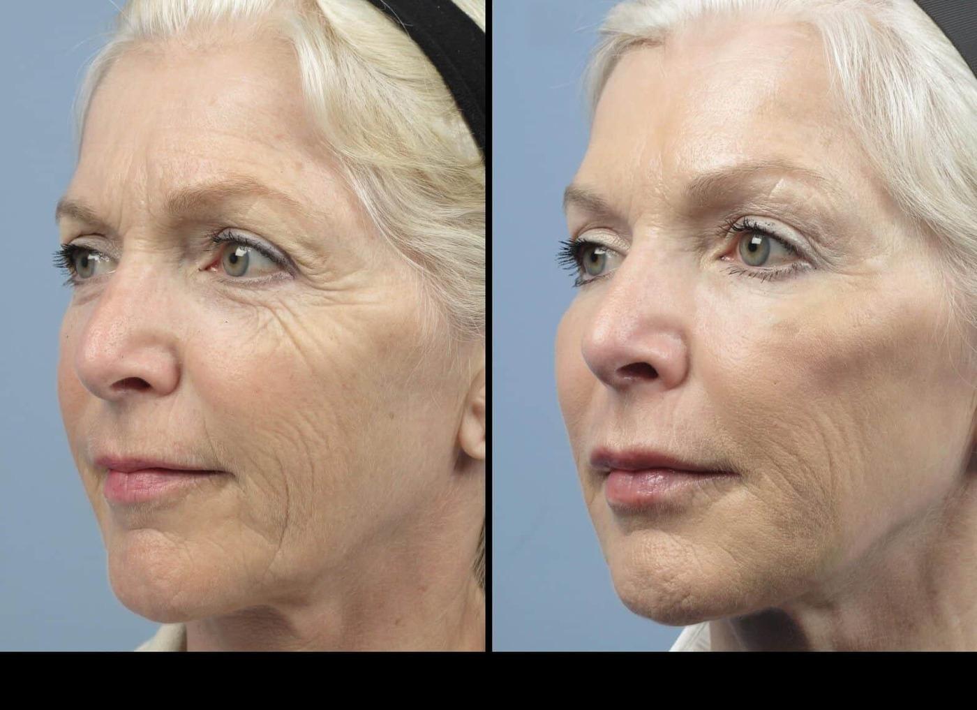 Photo 11 of a Patient Before and After Microdermabrasion in Toronto