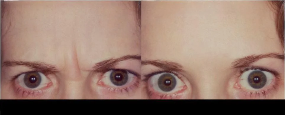Before and after Botox treatment in Toronto showing a patient with smoother skin and reduced forehead wrinkles.