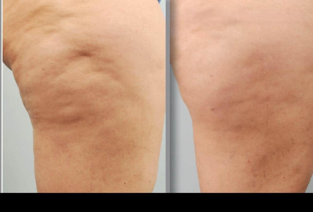 Before and after comparison of cellulite treatment in Toronto, highlighting reduced dimples and firmer skin.
