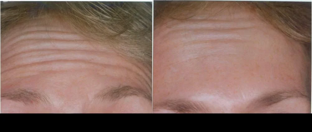 Before and after photo of a patient receiving Botox treatment in Toronto showing reduced forehead lines and smoother skin.