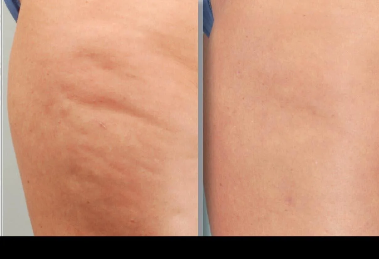 Patient's legs before and after cellulite treatment in Toronto, showing significant improvement in skin tone.
