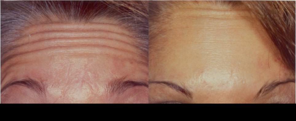 Botox treatment in Toronto before and after results showing a significant reduction in forehead wrinkles.