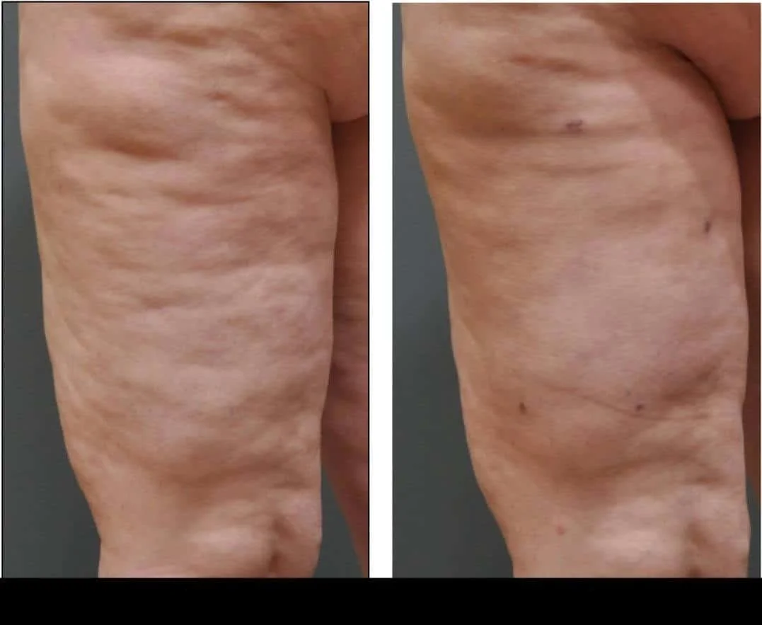 Cellulite reduction in Toronto results, demonstrating smoother thigh appearance before and after.