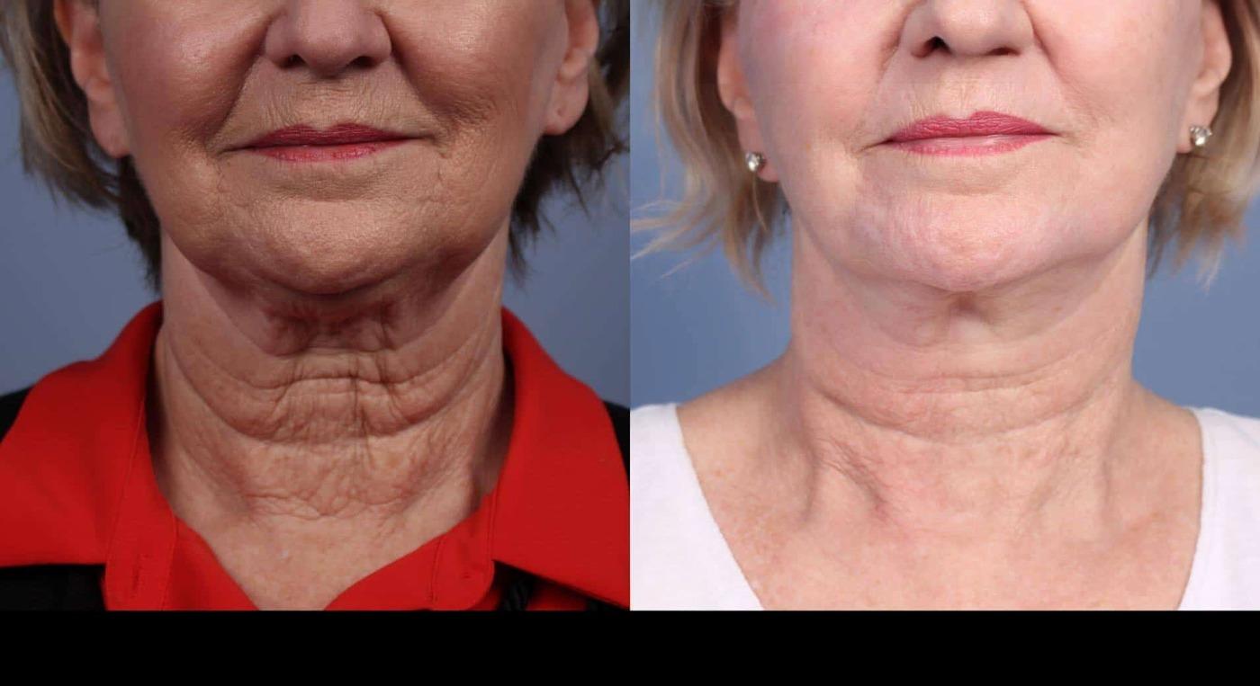 Photo 14 of a Patient Before and After Laser Wrinkle Removal in Toronto.