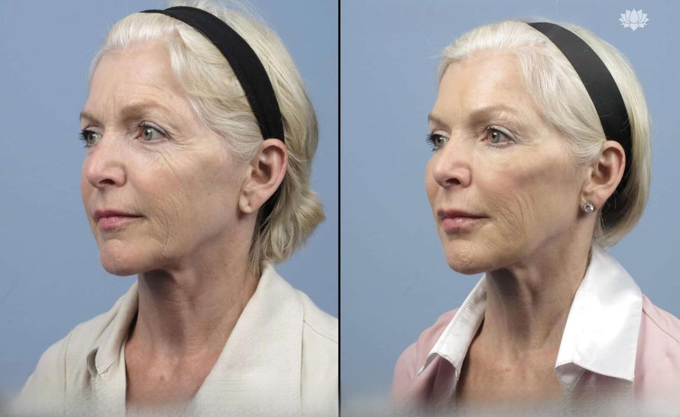 Photo 14 of a Patient Before and After Microdermabrasion in Toronto