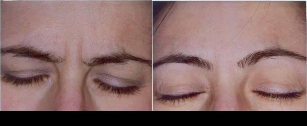 Before and after image of Botox in Toronto showing a patient with diminished frown lines and smoother skin between the eyebrows.