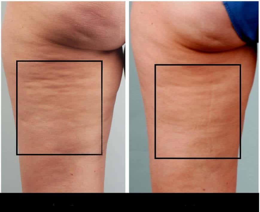 Thigh cellulite treatment in Toronto, with visible improvements in skin texture after the procedure.