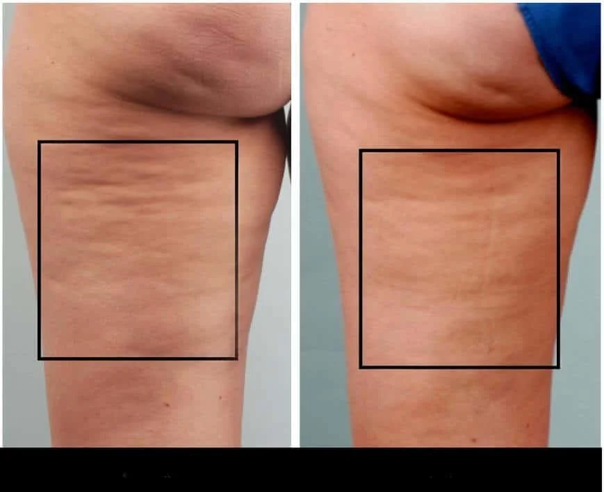 Thigh cellulite treatment in Toronto, with visible improvements in skin texture after the procedure.