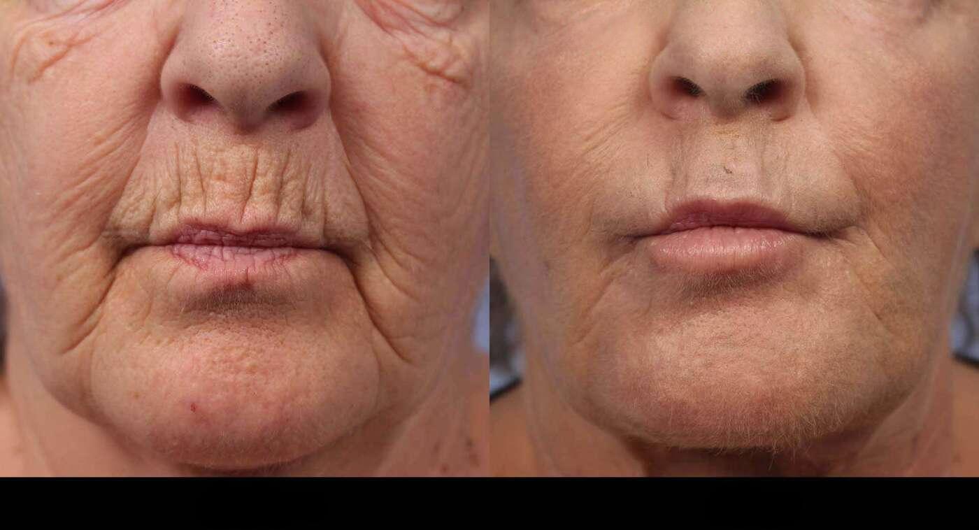 Photo 15 of a Patient Before and After Laser Wrinkle Removal in Toronto.
