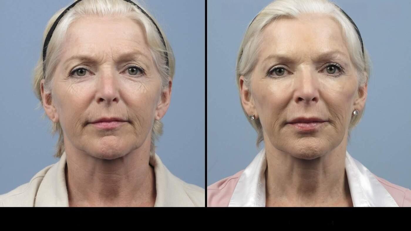 Photo 15 of a Patient Before and After Microdermabrasion in Toronto