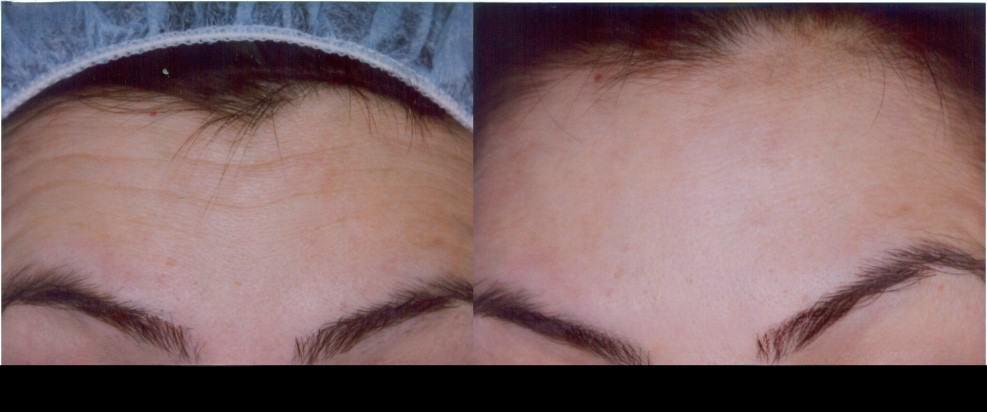 Botox in Toronto results with before and after images showcasing smoother forehead skin and reduced lines.