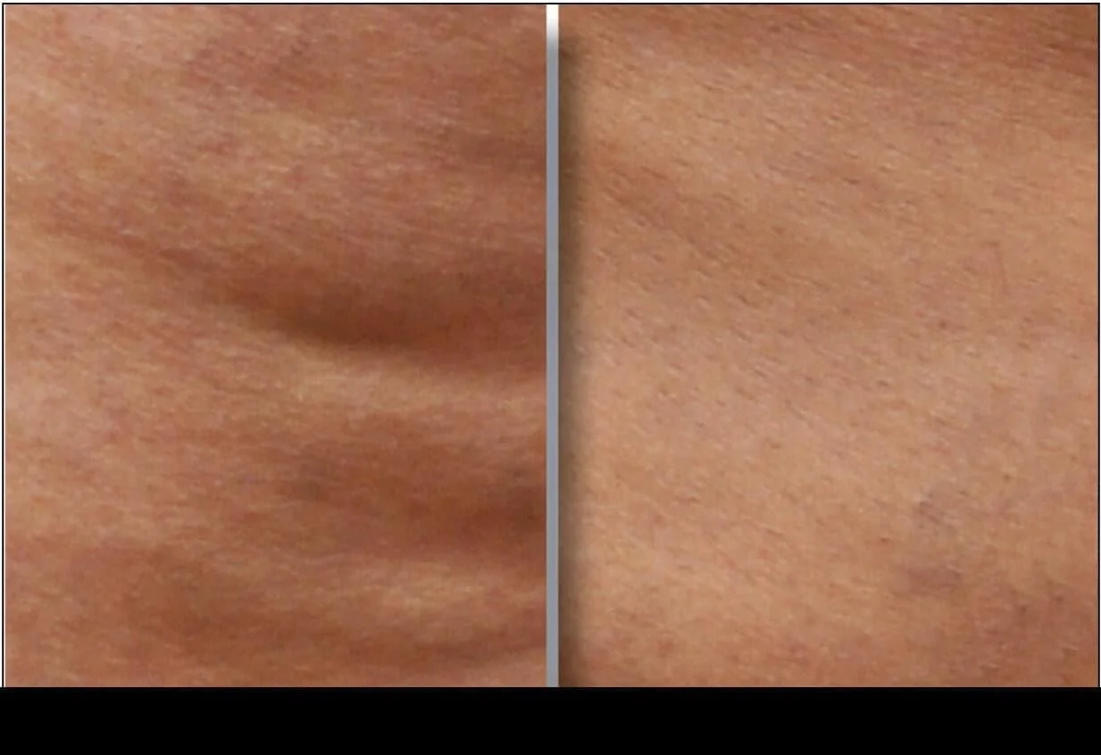 Side view of legs before and after cellulite removal in Toronto, showing smoother skin post-treatment.