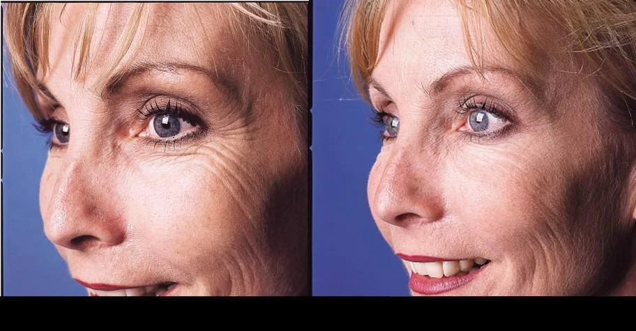 Botox treatment in Toronto before and after photos featuring a patient with reduced crow's feet and a smoother complexion.