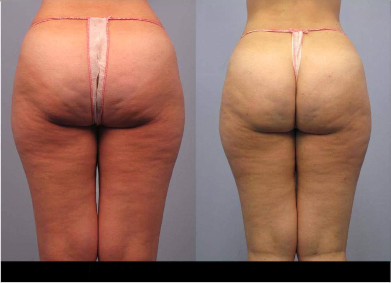 Before and after photos of a patient showing the results of cellulite removal in Toronto, focusing on the back of the thighs.
