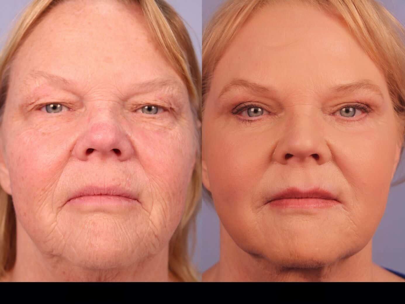 Photo 17 of a Patient Before and After Laser Wrinkle Removal in Toronto.