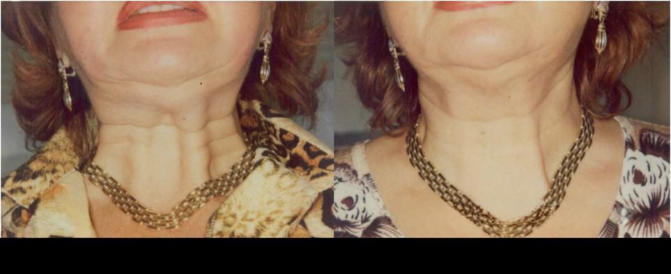 Before and after Botox treatment in Toronto showcasing improved neck skin appearance and reduced wrinkles.