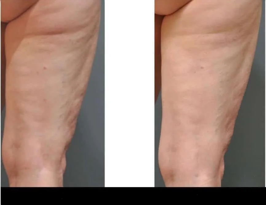 Before and after results highlighting successful cellulite reduction in Toronto, with a visible improvement in skin smoothness.