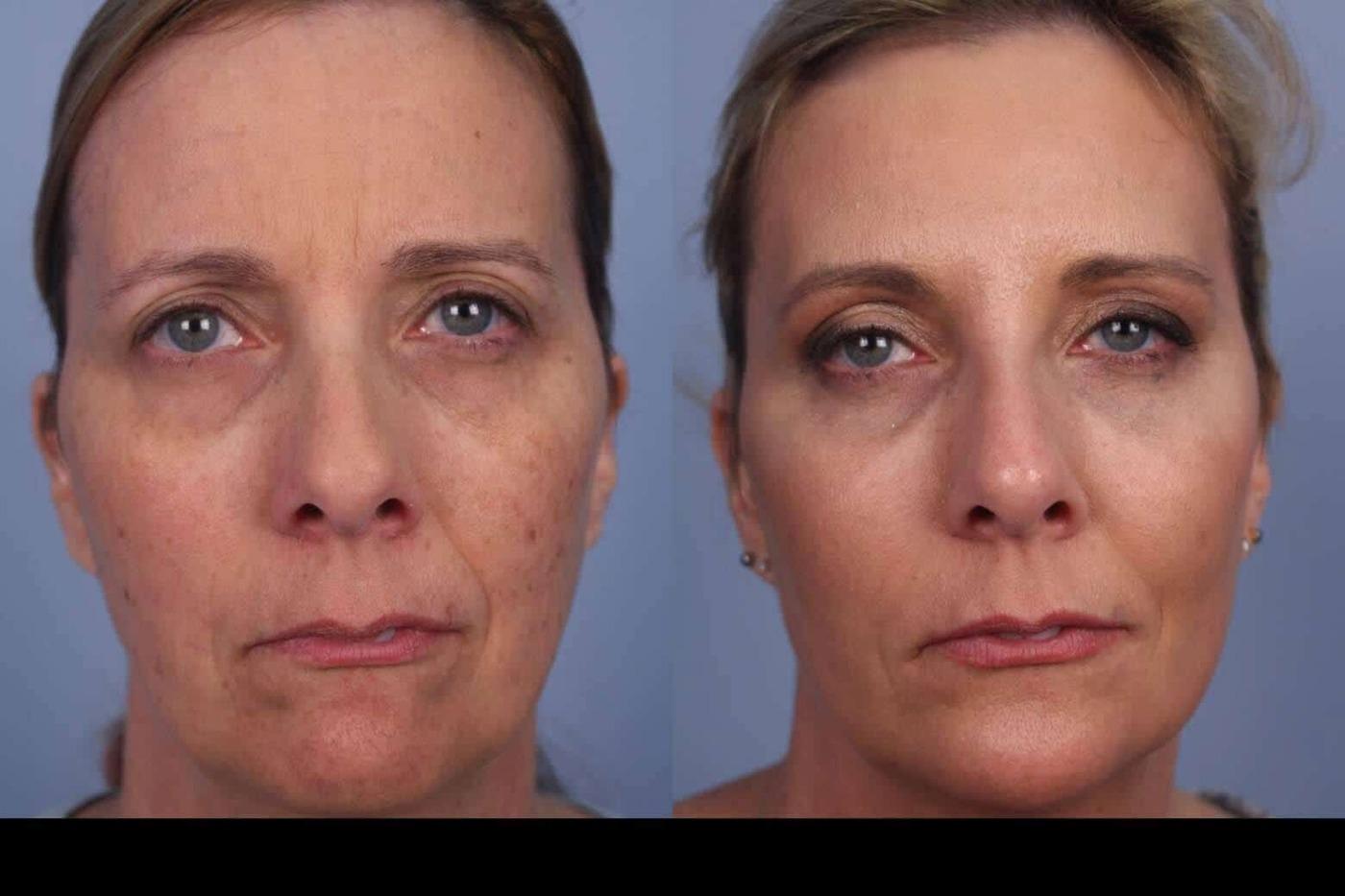 Photo 18 of a Patient Before and After Microdermabrasion in Toronto