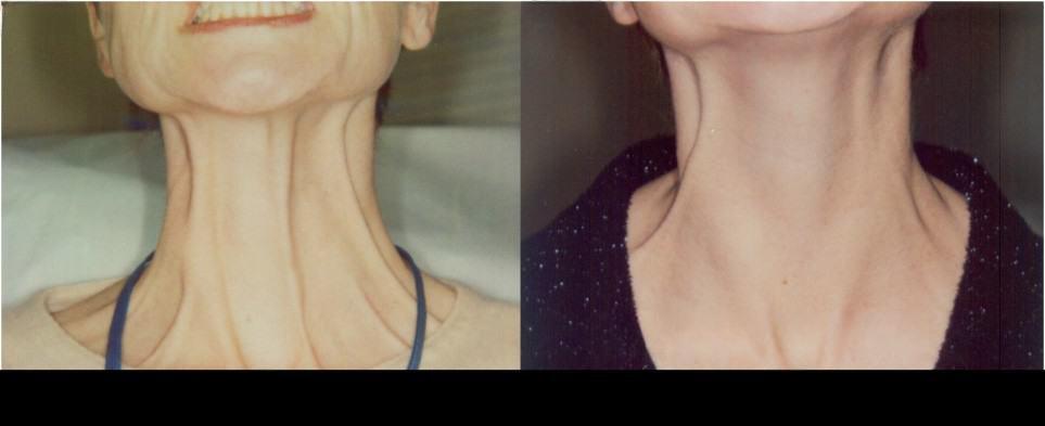 Before and after Botox treatment in Toronto showing improved neck skin appearance and reduced muscle banding.