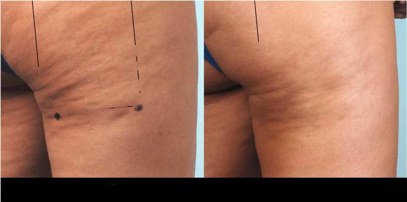 Patient's cellulite reduction treatment in Toronto showing a significant reduction in thigh dimpling.