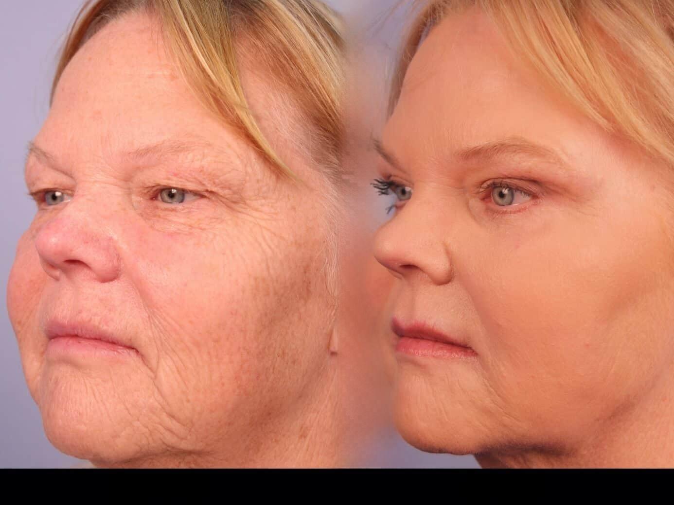 Photo 19 of a Patient Before and After Laser Wrinkle Removal in Toronto.