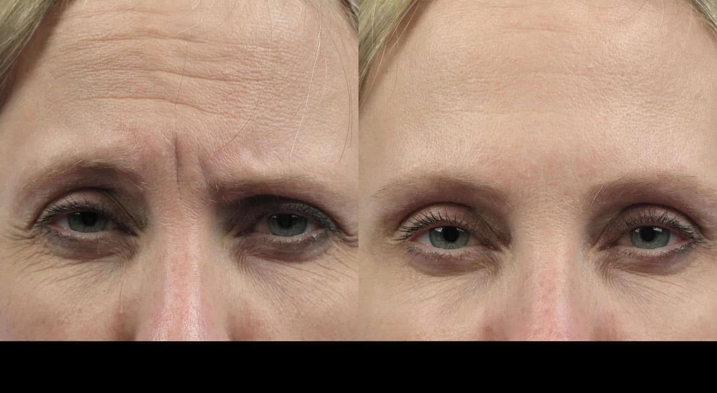 Comparison image of a patient before and after Botox in Toronto, highlighting smoother skin around the eyes and forehead.