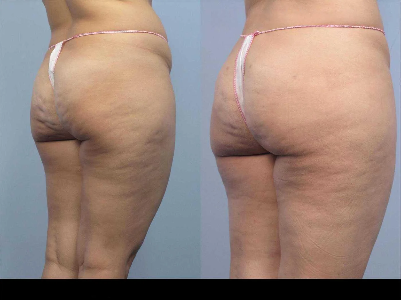 Cellulite removal in Toronto before and after photo highlighting smoother skin and less visible cellulite on the patient's thighs.