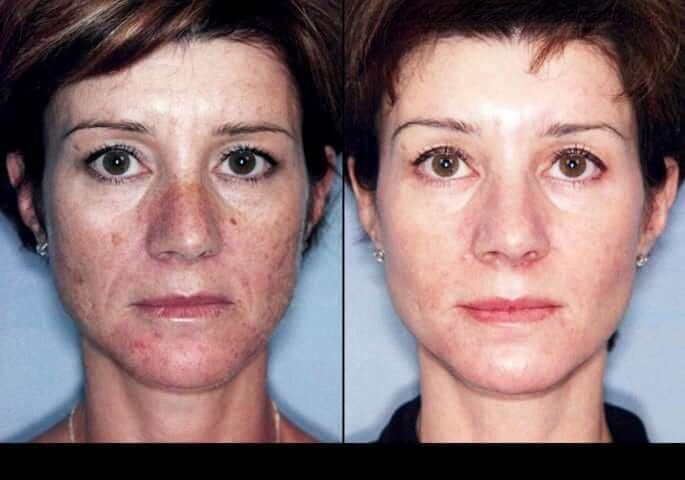 Photo 2 of a Patient Before and After IPL Photofacial Treatment in Toronto.