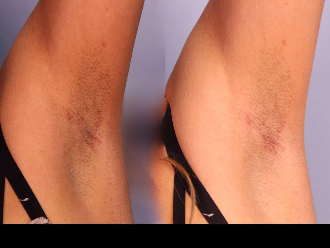 Photo 2 of a Patient Before and After Laser Hair Removal in Toronto.