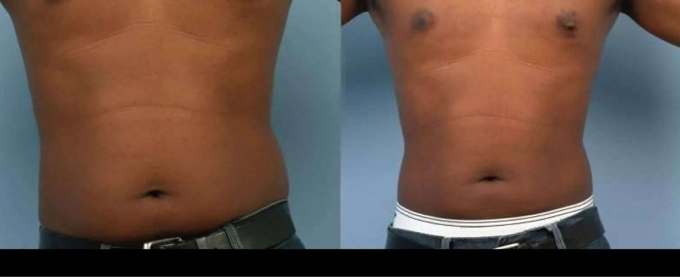 Photo 2 of a Patient Before and After Non-Surgical Body Contouring in Toronto.