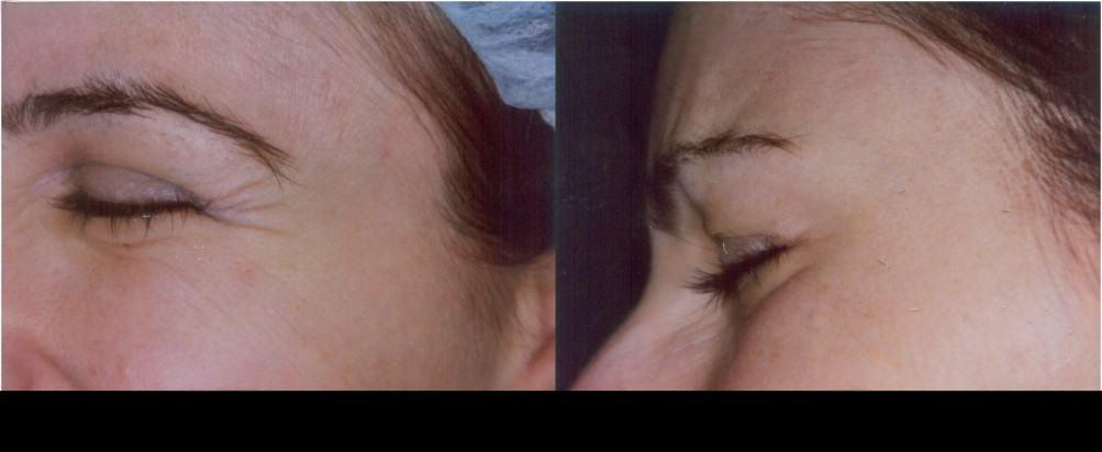 Botox in Toronto before and after image highlighting reduced crow's feet and smoother skin around the eyes.