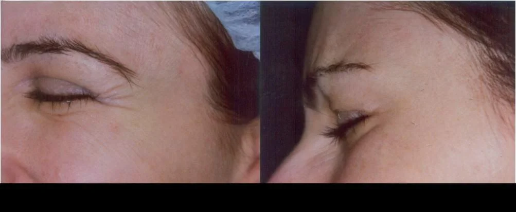 Botox in Toronto before and after image highlighting reduced crow's feet and smoother skin around the eyes.