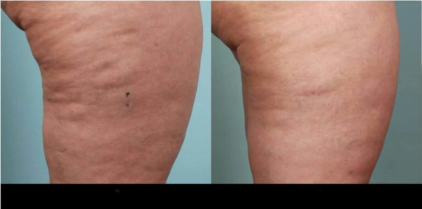 Before and after comparison of a patient's thighs following cellulite removal in Toronto.